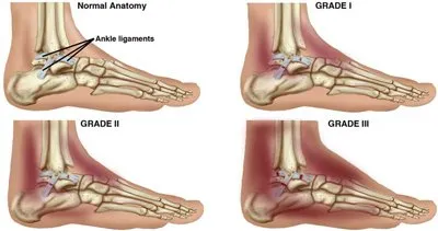 Choosing the Right Therapy for Ankle Strain: Understanding Overstretching and Tears from Running