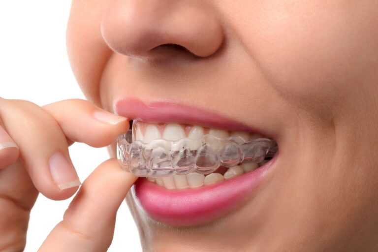 What You Need to Know About Caring for Your Invisalign Aligners in Las Vegas