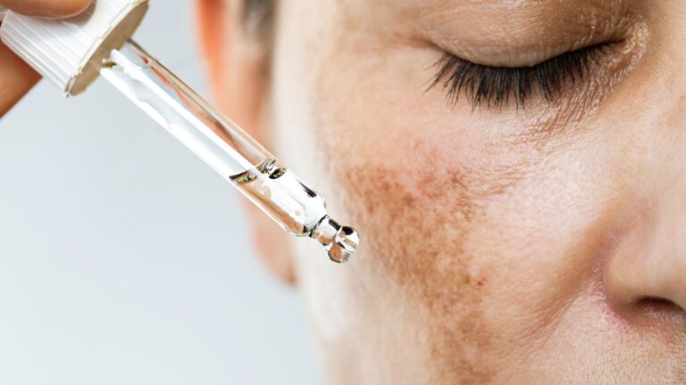 How Retinal Helps with Hyperpigmentation & Dark Spots