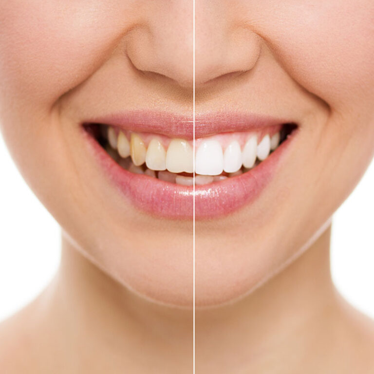 Teeth Whitening in Sydney: What You Need to Know Before Booking