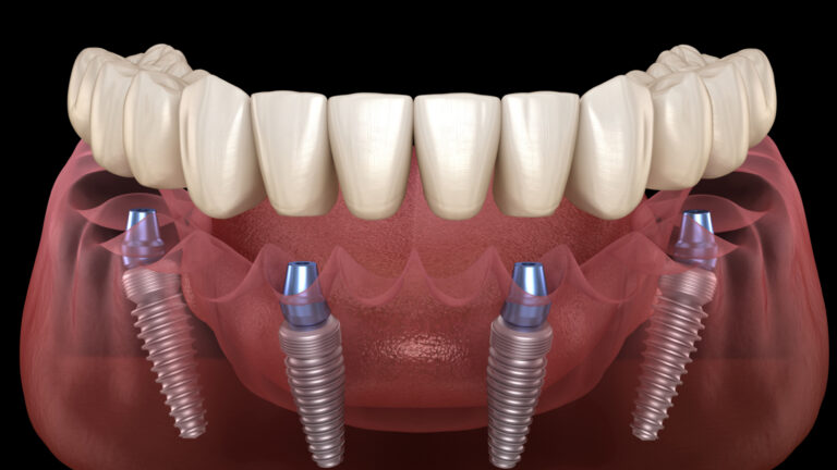 All-On-4 Dental Implants: What Patients Need to Know